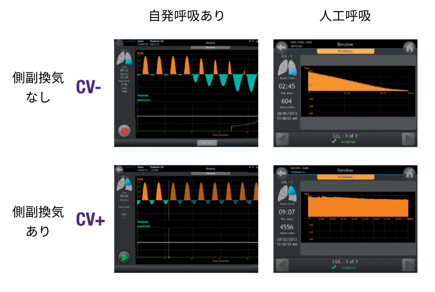 自発呼吸、側転換気のグラフ