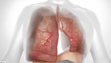 軟性気管支鏡を用いて標的肺葉にアプローチする様子