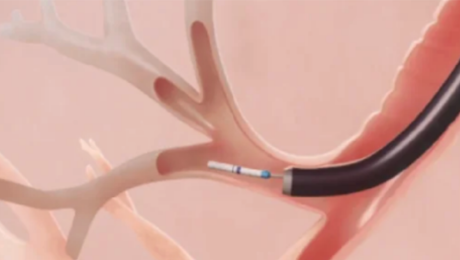 専用のデリバリーカテーテルで標的気管支にアプローチする様子