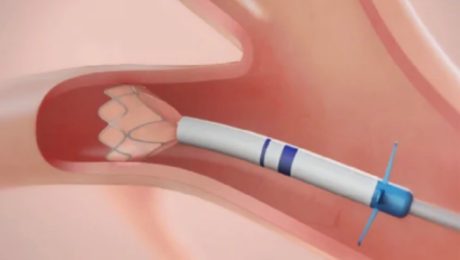 Zephyrバルブを標的気管支に留置する様子