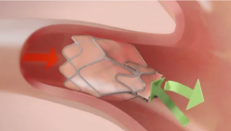 標的肺葉から空気が排出され流入が遮断される様子