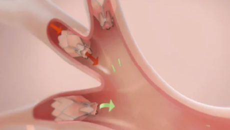 複数のZephyrバルブで標的肺葉を閉塞する様子