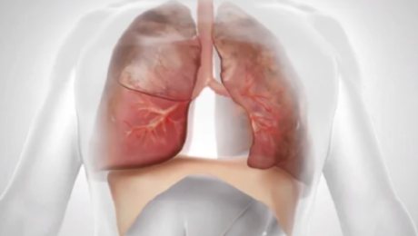 標的肺葉が減量し呼吸機能が改善する様子